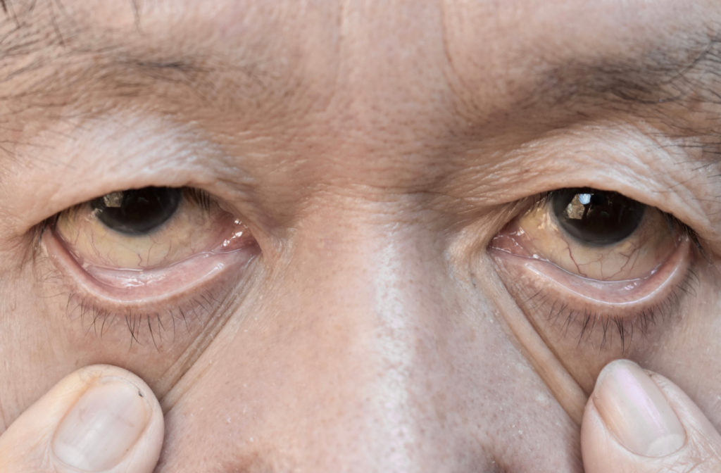 A senior pulling down their lower eyelids to reveal pale color on the skin of their eyelids, which can be a sign of anemia.
